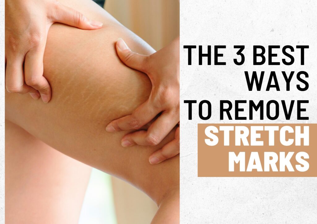 3 best Ways to Remove Stretch Marks